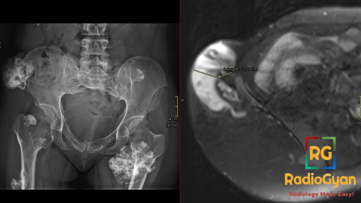 Axial pelvic MRI shows a right iliac osteochondroma with a thick 2.37-cm cartilage cap, suggesting malignant transformation.