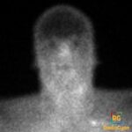Frontal brain perfusion nuclear medicine image shows the hot-nose sign, severe hypoxic injury, and reduced cerebral uptake