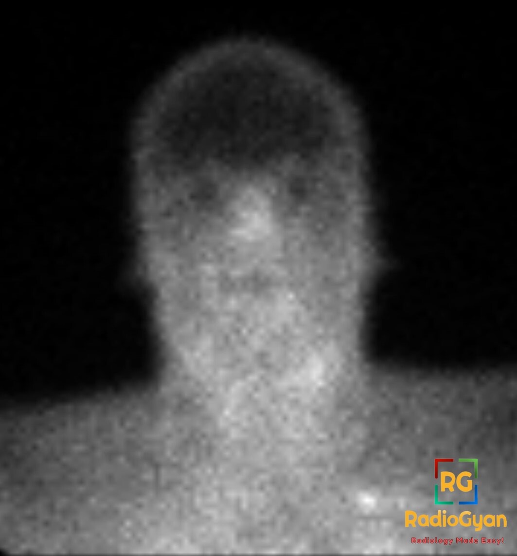 Frontal brain perfusion nuclear medicine image shows the hot-nose sign, severe hypoxic injury, and reduced cerebral uptake