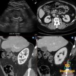 Sagittal right renal ultrasound and axial and coronal CT show an interpolar column of Bertin enhancing like adjacent cortex.