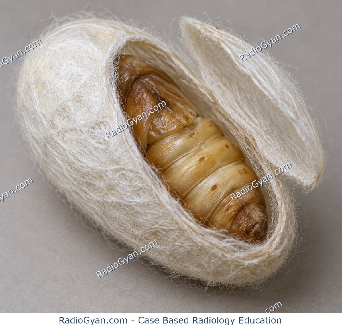 A silk cocoon enveloping a pupa, illustrating the encapsulation seen in the Abdominal Cocoon Sign.
