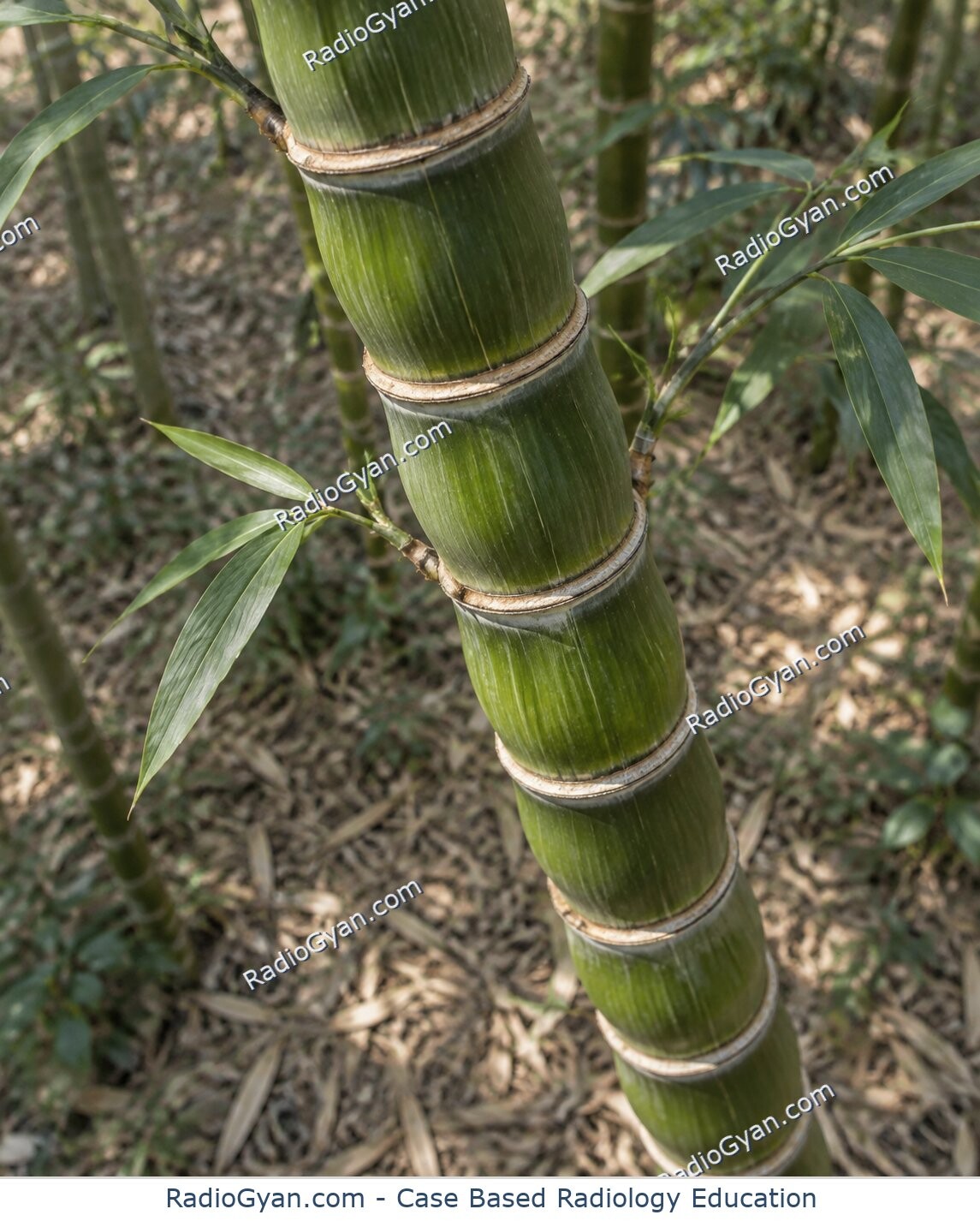 A segmented bamboo stalk illustrating the bamboo spine sign.