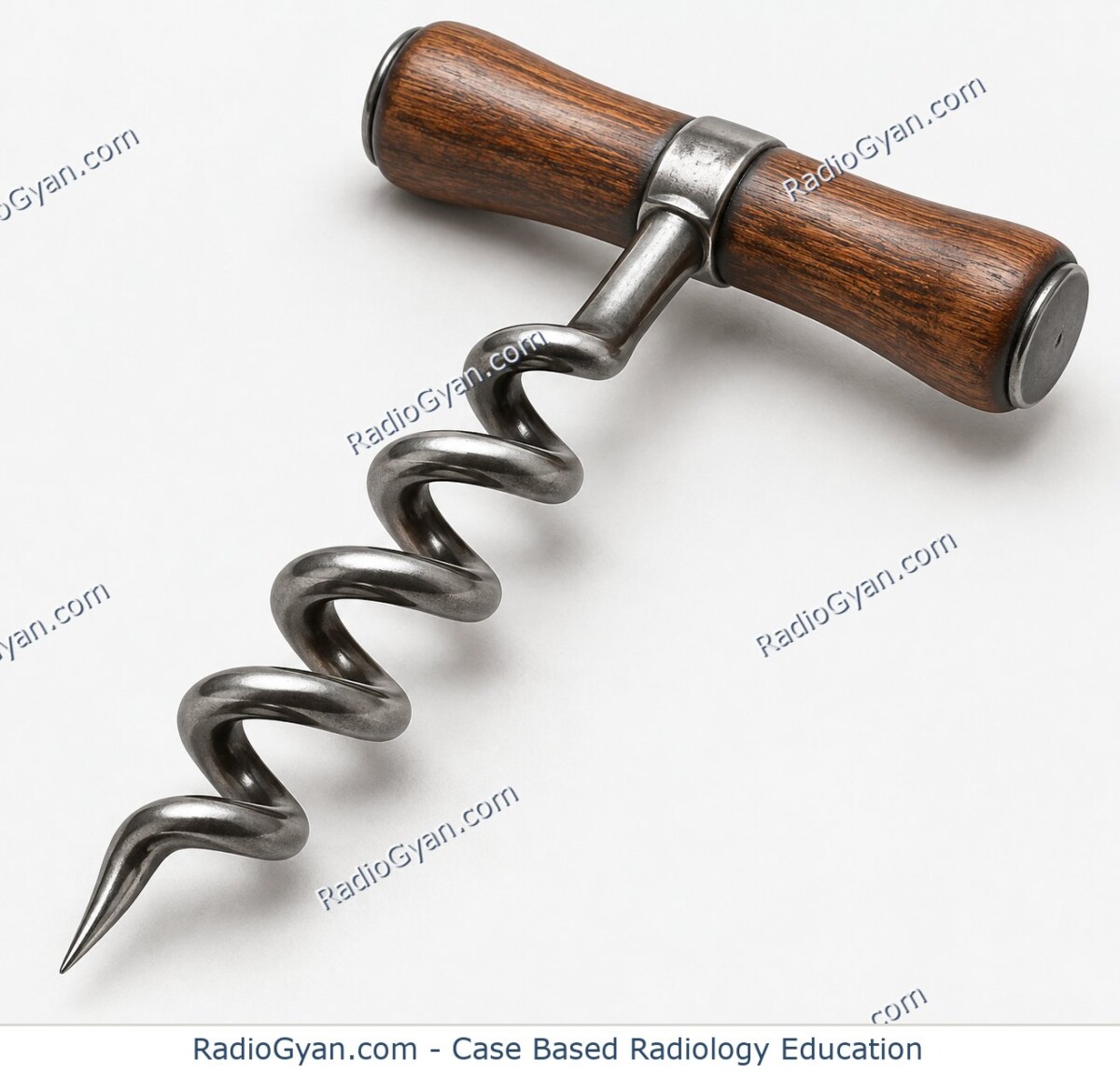 A traditional spiral corkscrew illustrating the corkscrew sign of small-bowel volvulus.