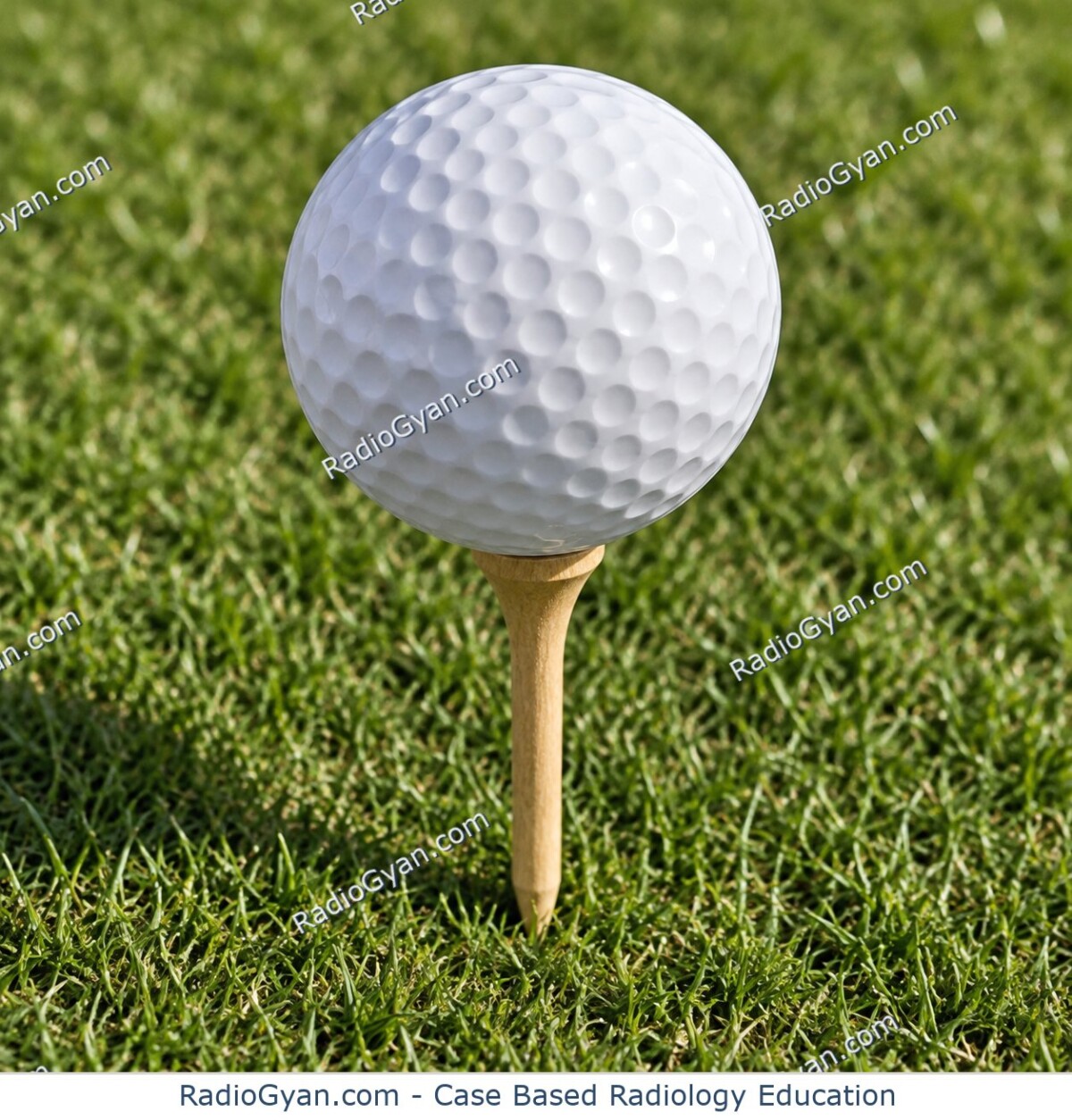 A dimpled golf ball perched on a tee, illustrating the golf-ball-on-tee sign in renal papillary necrosis.