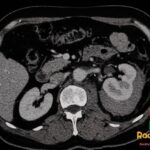 Axial contrast-enhanced CT shows a left perinephric hematoma compressing the kidney after biopsy, causing Page kidney.