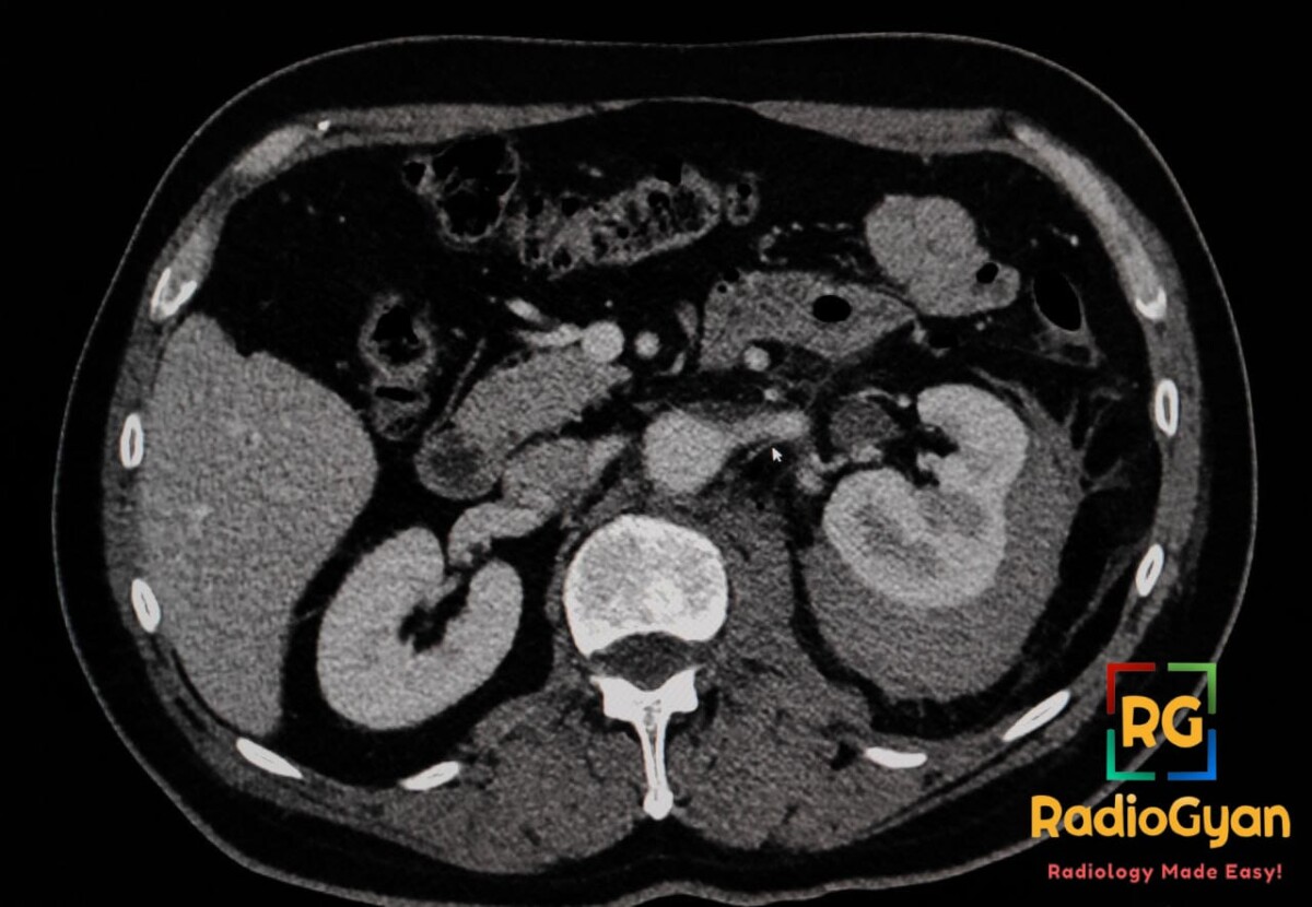 Axial contrast-enhanced CT shows a left perinephric hematoma compressing the kidney after biopsy, causing Page kidney.