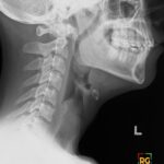 Lateral neck radiograph shows marked tonsillar and mild adenoid enlargement with oro- and nasopharyngeal narrowing