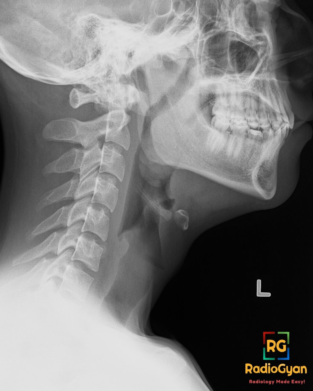 Lateral neck radiograph shows marked tonsillar and mild adenoid enlargement with oro- and nasopharyngeal narrowing