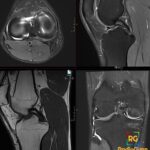 Axial, sagittal and coronal right knee MRI shows a displaced medial meniscal fragment paralleling the PCL, with joint fluid.
