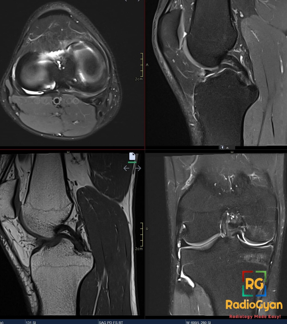 Axial, sagittal and coronal right knee MRI shows a displaced medial meniscal fragment paralleling the PCL, with joint fluid.