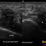 Longitudinal ultrasound of the right plantar foot shows a hypoechoic Morton neuroma in the second interspace, noncompressible.
