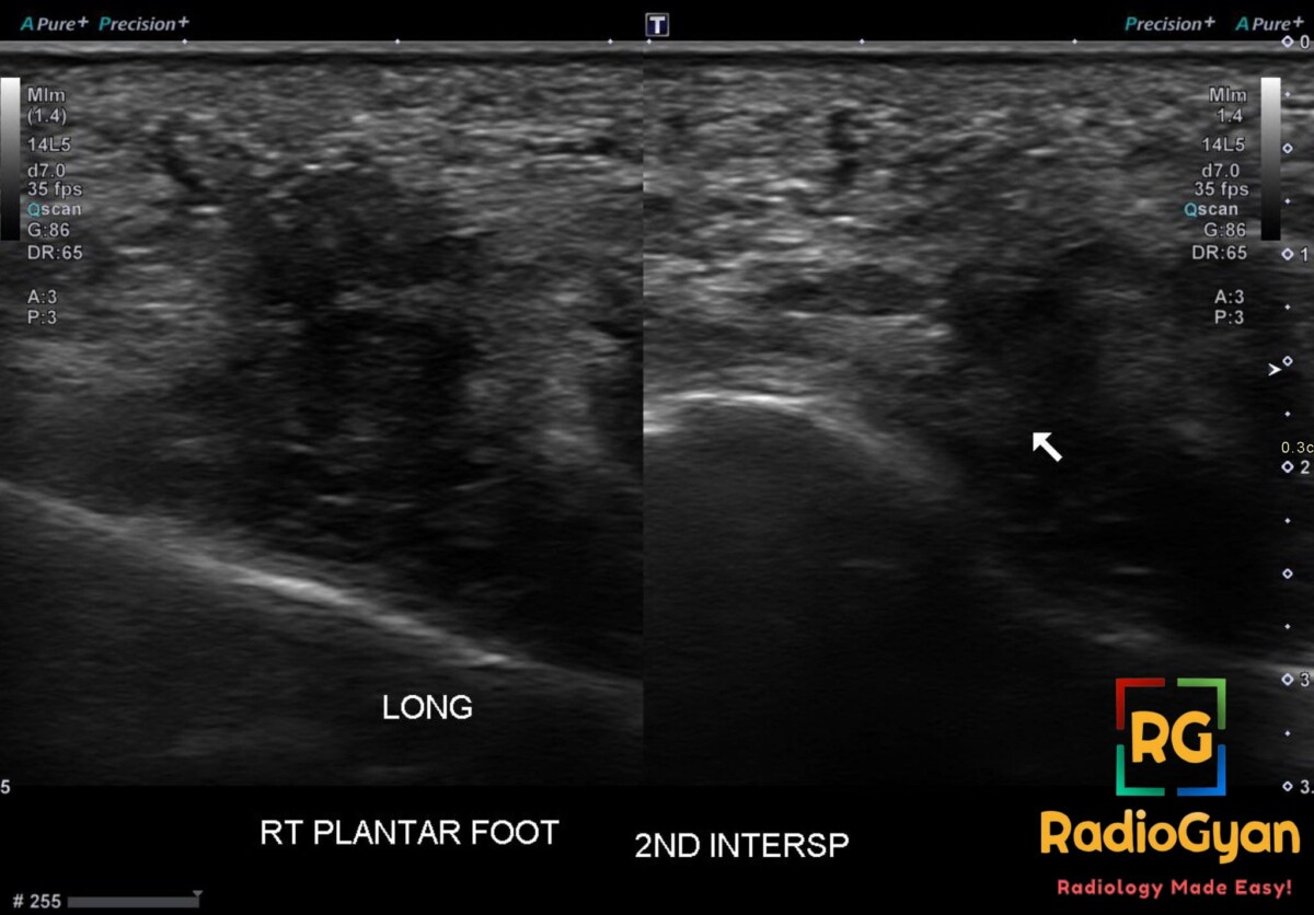Longitudinal ultrasound of the right plantar foot shows a hypoechoic Morton neuroma in the second interspace, noncompressible.