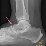 Lateral ankle X-ray shows an os supranaviculare, a small accessory ossicle dorsal to the talonavicular joint.