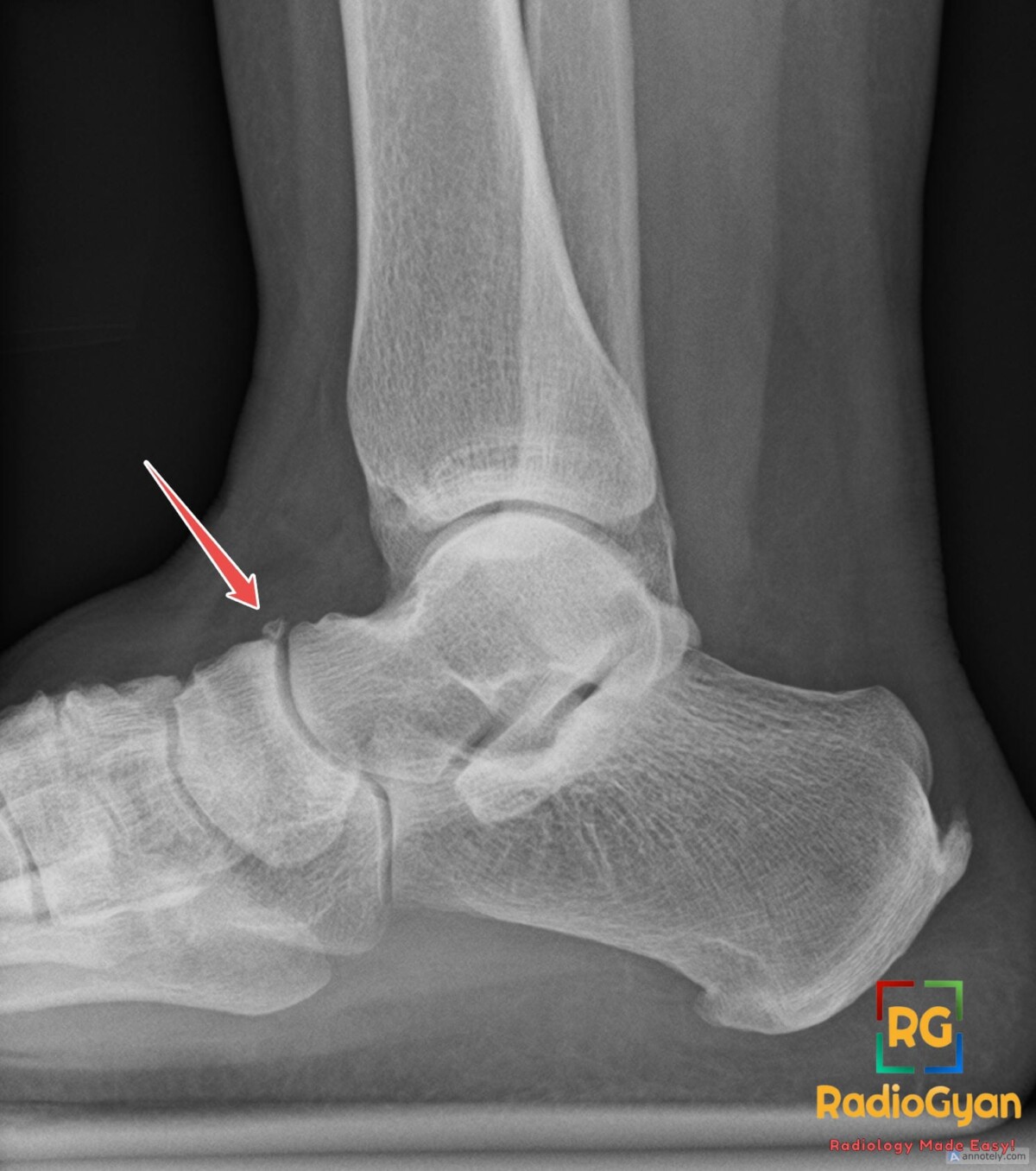 Lateral ankle X-ray shows an os supranaviculare, a small accessory ossicle dorsal to the talonavicular joint.