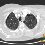 Axial chest CT shows paraseptal emphysema in both upper lobes with multiple subpleural bullae and peripheral lucencies.