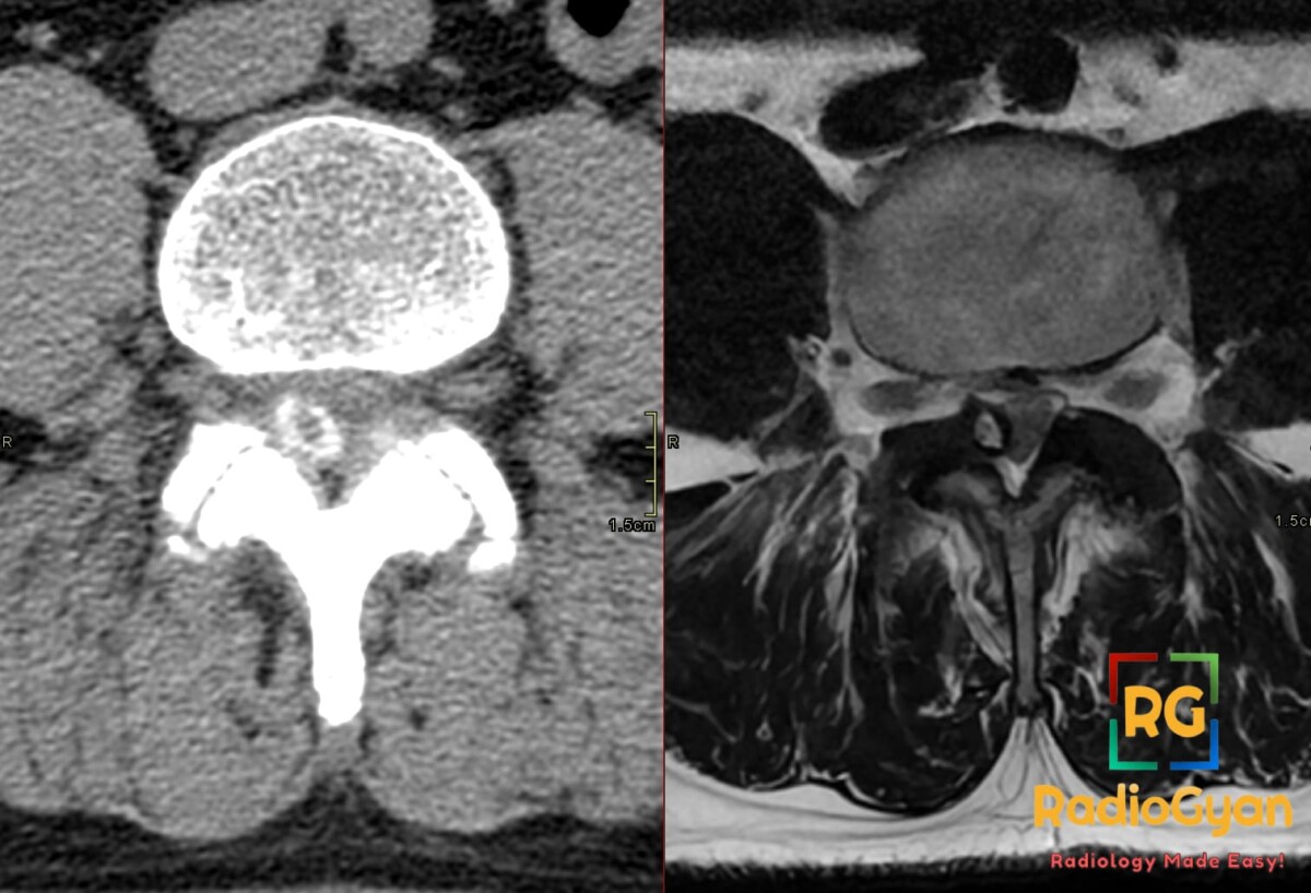 Axial CT and MRI show a peripherally calcified right synovial cyst compressing the right L5 nerve root in the spinal canal.