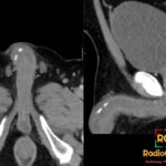 Coronal and sagittal CT show curvilinear dorsal penile calcifications consistent with Peyronie disease plaque.