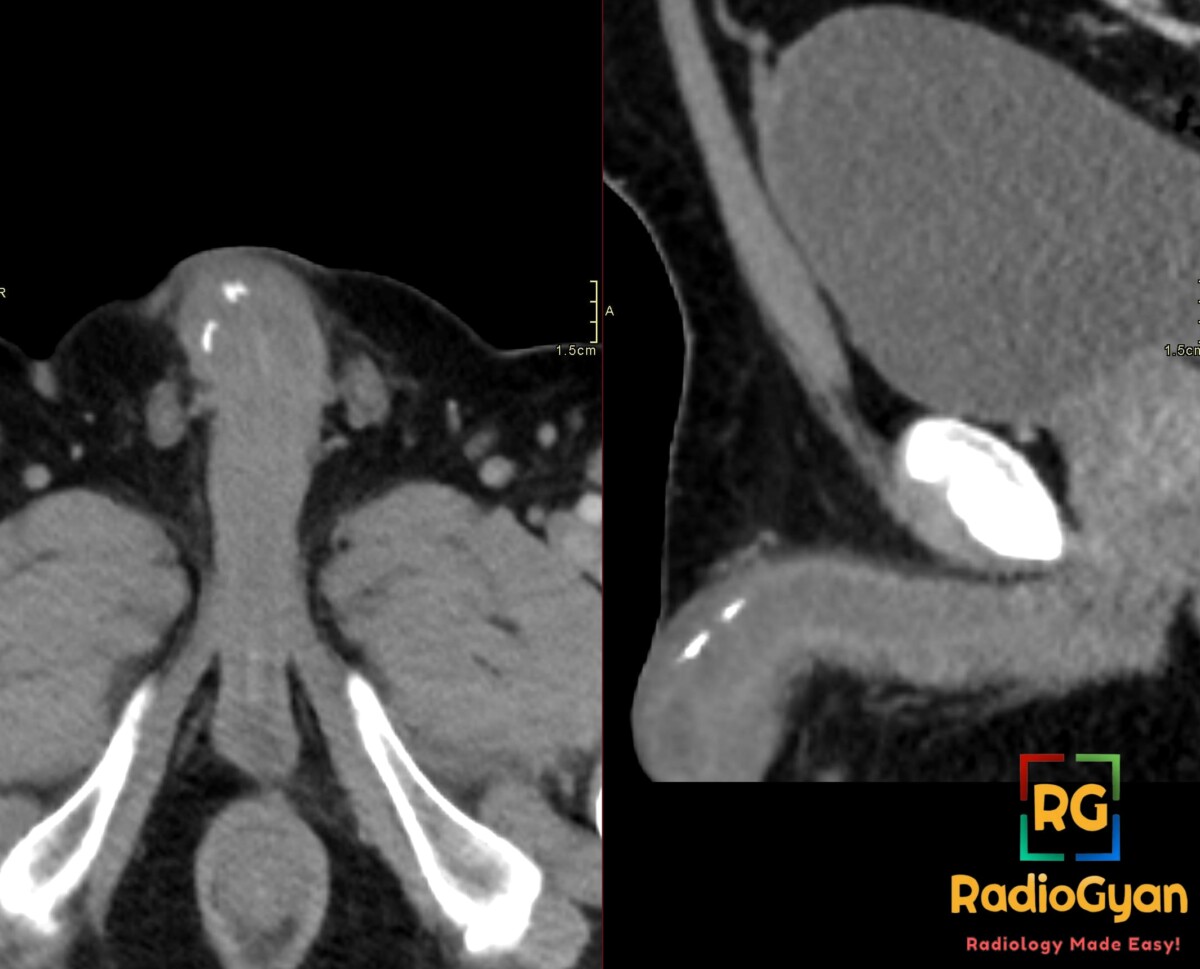 Coronal and sagittal CT show curvilinear dorsal penile calcifications consistent with Peyronie disease plaque.
