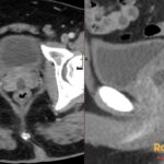 Axial and sagittal pelvic CT showing a midline prostatic utricle cyst, an incidental fluid-filled lesion posterior to the prostate.