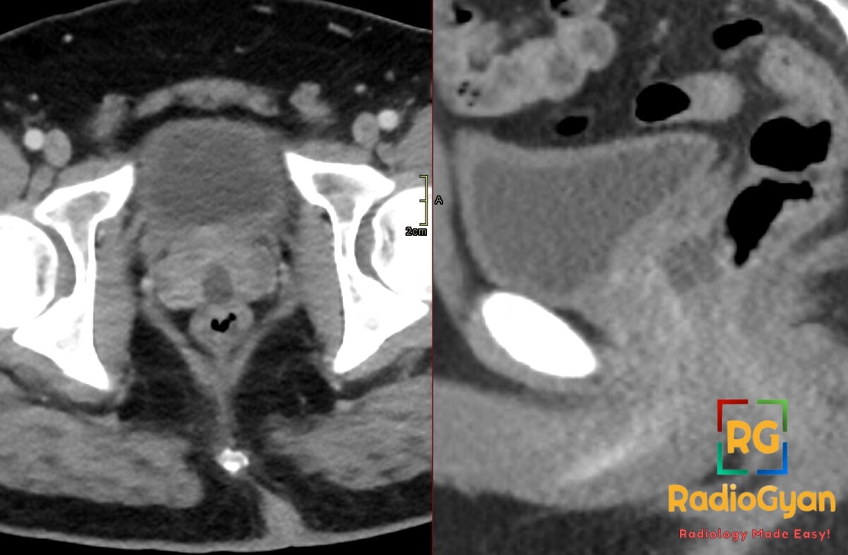 Axial and sagittal pelvic CT showing a midline prostatic utricle cyst, an incidental fluid-filled lesion posterior to the prostate.