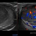 Sagittal right testicular ultrasound shows a solid seminoma with marked internal vascularity and heterogeneous echotexture