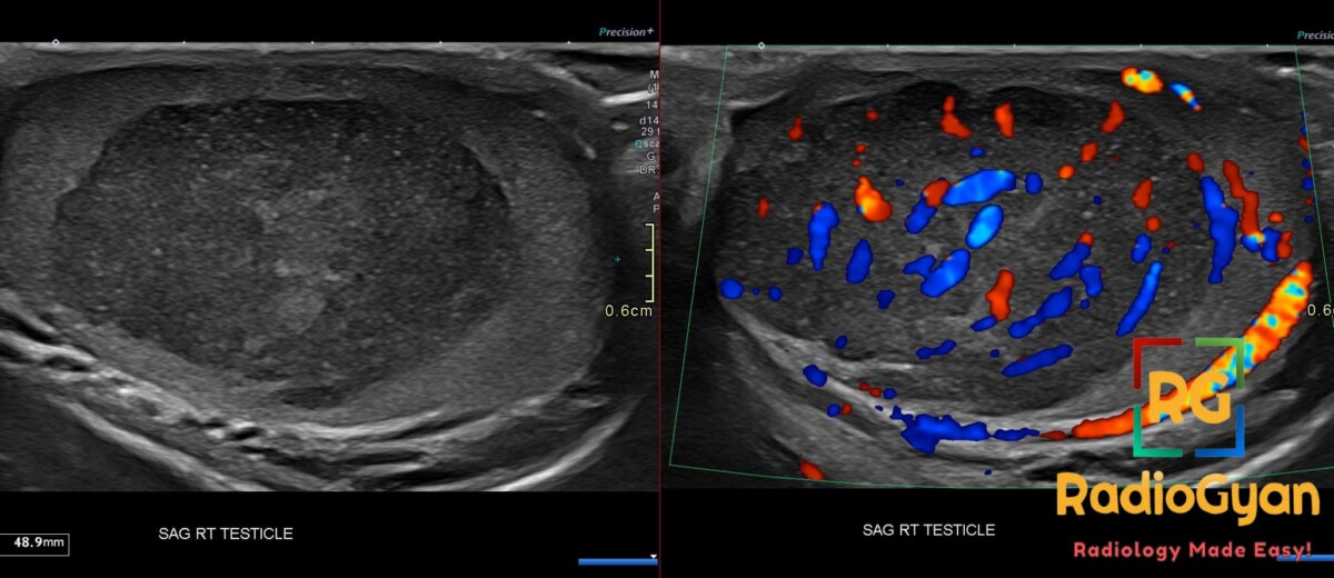Sagittal right testicular ultrasound shows a solid seminoma with marked internal vascularity and heterogeneous echotexture