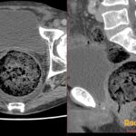 Axial and sagittal pelvic CT showing a large midline rectal fecaloma with mottled gas and circumferential wall thickening