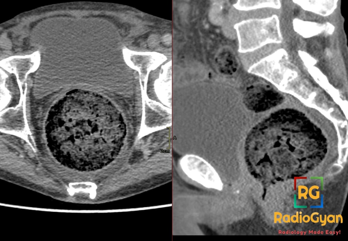 Axial and sagittal pelvic CT showing a large midline rectal fecaloma with mottled gas and circumferential wall thickening
