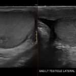 Sagittal bilateral testicular ultrasound shows rete testis ectasia as clustered anechoic channels at both mediastina.
