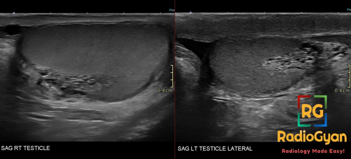 Sagittal bilateral testicular ultrasound shows rete testis ectasia as clustered anechoic channels at both mediastina.